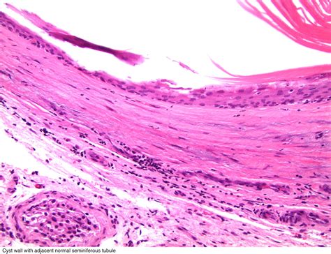 Pathology Outlines Epidermoid Cyst