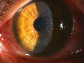 Adenoviral Conjunctivitis