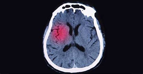 Alzheimer Y Lesión Cerebral Traumática ¿afectan El Cerebro De Manera