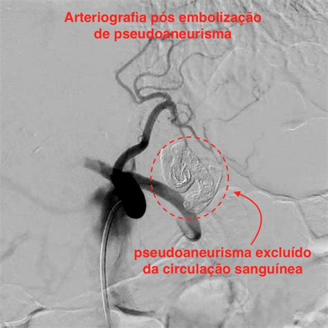 Medicina Intervencionista Embolização de aneurismas e pseudoaneurismas