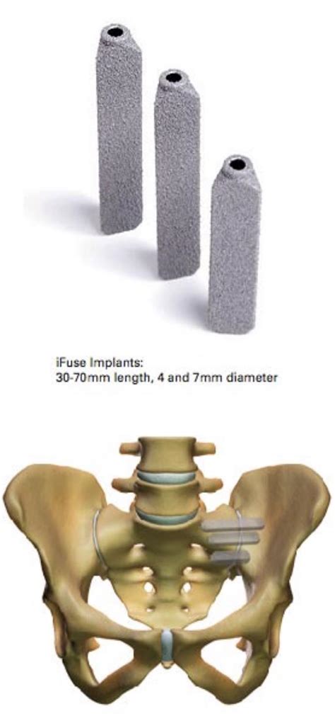 Sacroiliac Joint Disease Minimally Invasive Surgery With Ifuse