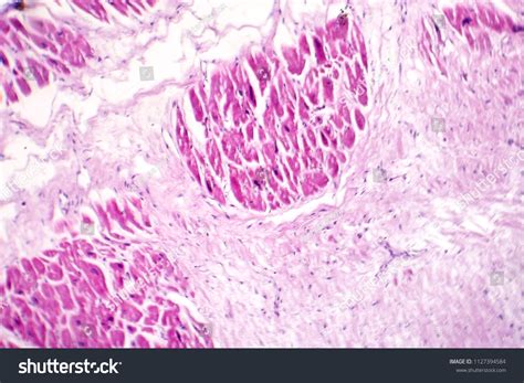 Acute Myocardial Infarction Histology Heart Tissue Stock Photo