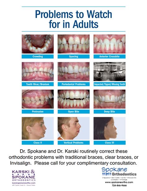 Crossbite Teeth Braces