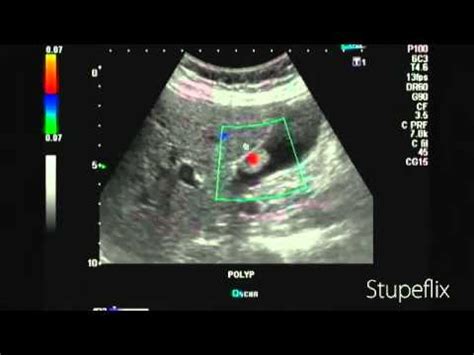 Gallbladder Polyp Color Doppler Ultrasound