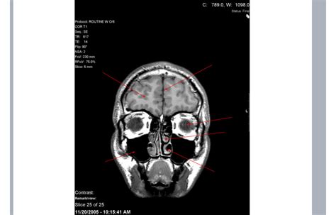 CT Scan Brain pt 2 slice 1 Diagram | Quizlet