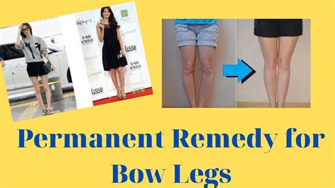 Bow Legs How To Fix Bow Legs Health Fitness Expert YouTube