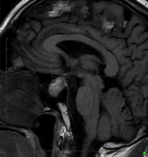 Sagittal T1 Weighted Noncontrast Mri Showing Hyperintense Pituitary