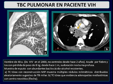 Figure From Manifestaciones Radiol Gicas De La Tuberculosis Pulmonar