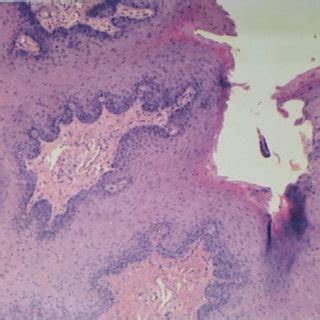 Histology of the lesions. Diagnosis of squamous cell papilloma (20×20 ...