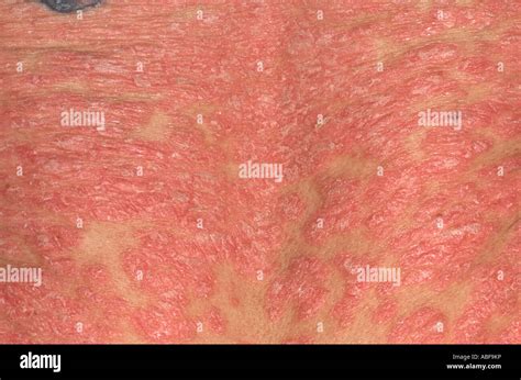 Cutaneous Rash Hi Res Stock Photography And Images Alamy