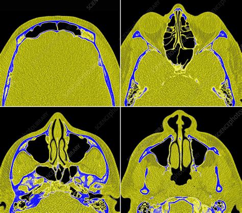 Normal Sinuses Ct Scan Stock Image C0294635 Science Photo Library