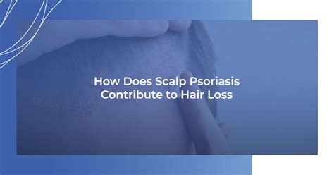 How Does Scalp Psoriasis Contribute to Hair Loss