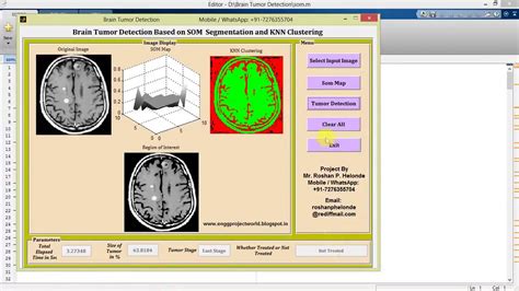 Brain Tumor Detection Using Segmentation And Knn Clustering Matlab