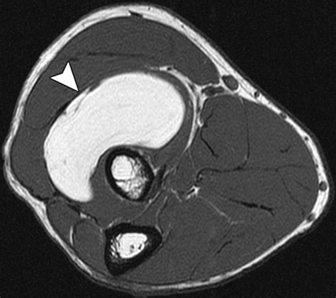 Soft Tissue Tumors And Tumorlike Lesions A Systematic Imaging Approach