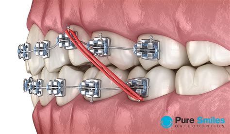 Are Rubber Bands Necessary For Orthodontic Treatment?