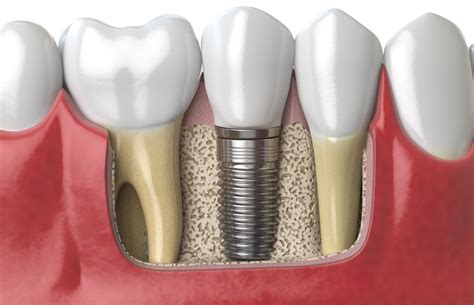 Differences Between Dental Implants Dentures The Dental Lounge