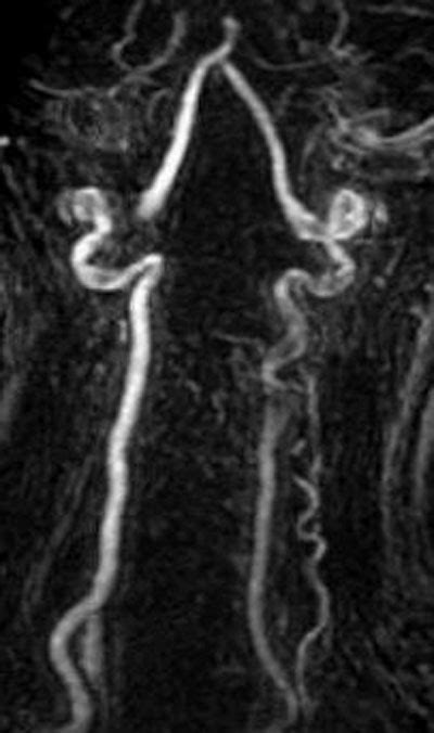 Tof Mra Artifacts Questions And Answers In Mri