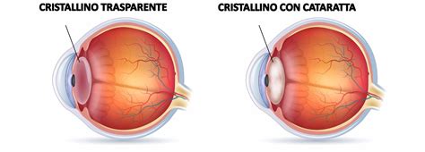 Cataratta Dott Marcello Minicucci