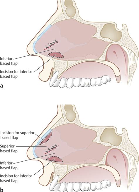 14 Unilateral Mucosal Advancement Flap | Plastic Surgery Key