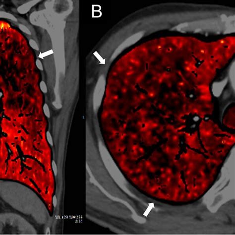 Dual Energy Computed Tomography Images A B A Color Coded Iodine