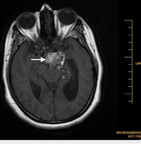 Figure 1 From Magnetic Resonance Imaging Findings In A Rare Case Of A