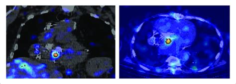 99mTc HMPAO Labeled Leukocyte Scintigraphy With SPECT CT In Coronal