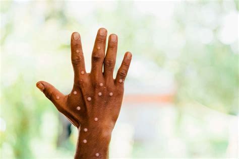 Mpox Fourth Case Confirmed In Kenya Nation