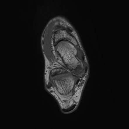 Talocalcaneal Coalition Image Radiopaedia Org