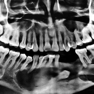 Orthopantomogram With Multiple Multilocular Radiolucent Lesions In The