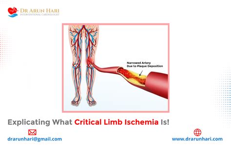 Explicating What Critical Limb Ischemia Is Dr Arun Hari