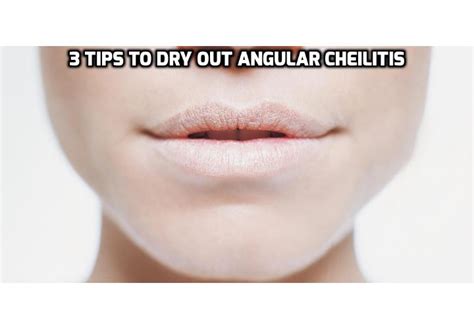 3 Tips To Dry Out Angular Cheilitis Anti Aging Beauty Health