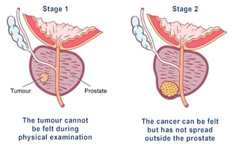 Prostate Problems And Symptoms Somerset Prostate Support Association