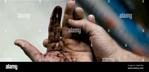 INFECTED FINGER, SPLINTER, 2008 Stock Photo - Alamy