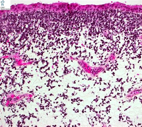 Botryoid Rhabdomyosarcoma Human Pathology