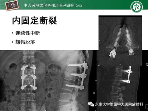 脊柱术后的影像评估放射科脊柱影像评估 健康界