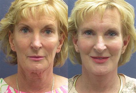 Best Neck Lift Boca Raton Florida Dr Albert Dabbah