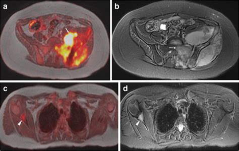 Staging Of Metastatic Ewing Sarcoma In A 12 Year Old Girl A Fused