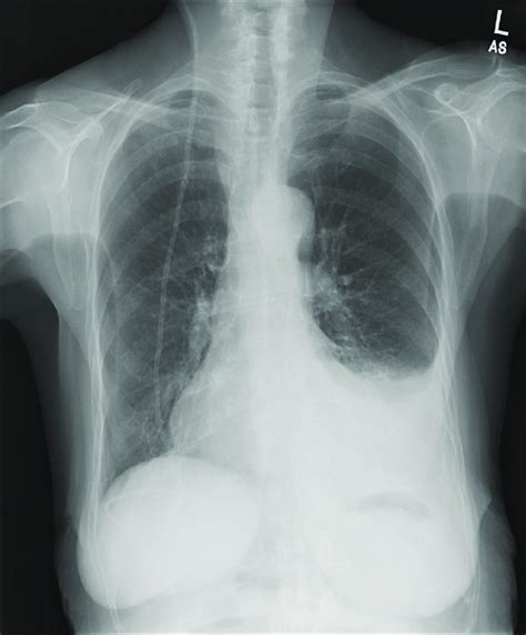 Chest X-ray showing right-sided ventricular-peritoneal shunt and left ...