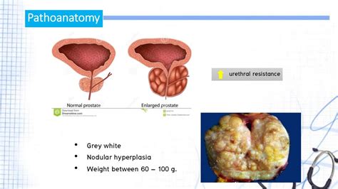 Benign Prostatic hyperplasia