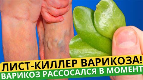 ПРИРОДНЫЙ КИЛЛЕР ВАРИКОЗА И СОСУДИСТЫХ ЗВЕЗДОЧЕК! За 15 минут в день ...