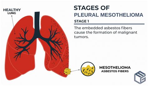 How Common Are Asbestos Related Diseases Elg Law