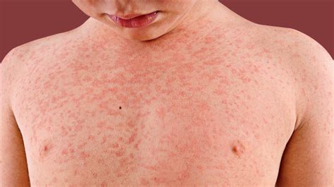 Measles Causes Symptoms And Treatment Off