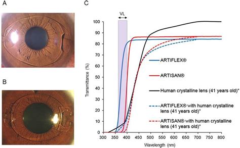 The Two Types Of Iris Fixated Phakic Intraocular Lens Piol A