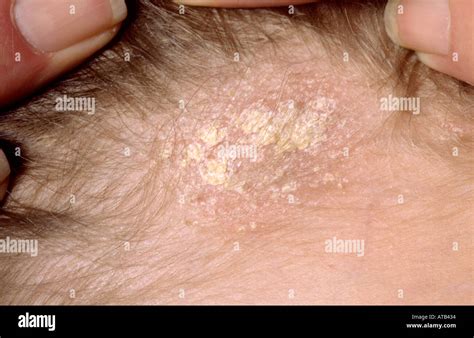 Tinea Capitis Images