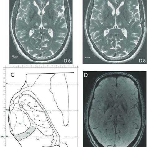 Axial T2 Weighted MR Images A And B Obtained 2 Days After Treatment