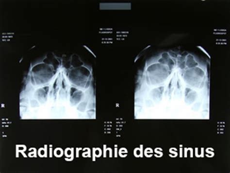 Dorloter Enthousiasme Plus Comment Se Passe Un Scanner De L Oreille