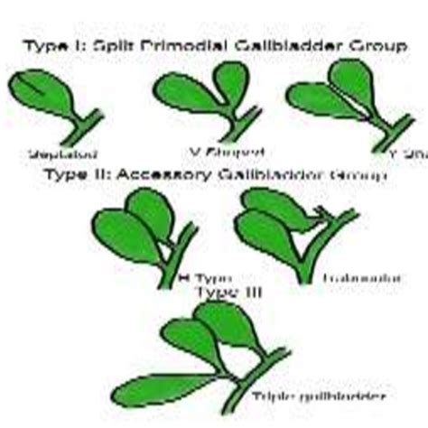 Pdf Bilobed Gallbladder A Rare Congenital Anomaly Of The Biliary System