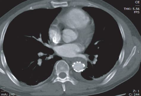 A Ct Angiography Scan Revealed Double Lumen Aortic Arch Structure