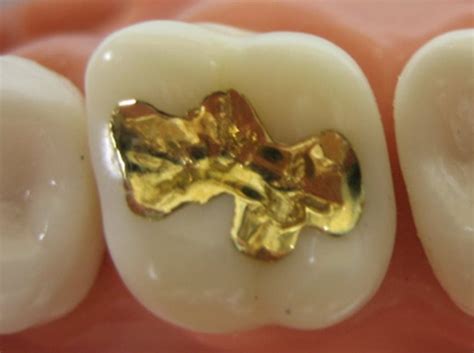 Cavity Filling Gold