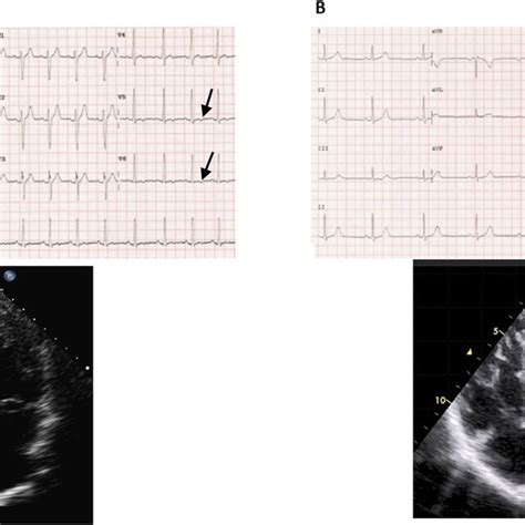 Twelve Lead Electrocardiogram In Two Cases Of Augmented Left